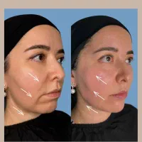 فقط فردا چهارشنبه ۹۸۰ /کانتورینگ/فیلر/تعدادمحدود|خدمات آرایشگری و زیبایی|رشت, کوی حسینی|دیوار
