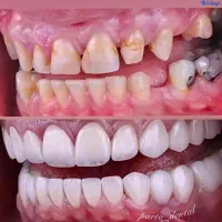 خدمات دندانپزشکی تهرانپارس شرایط اقساط ایمپلنت