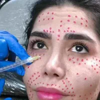 تخفیف ویژه اموزش تزریق بوتاکس و فیلر|خدمات آموزشی|ارومیه, |دیوار