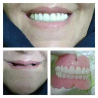 ساخت دندان مصنوعی باکیفیت وضمانت|خدمات آرایشگری و زیبایی|نهاوند, |دیوار