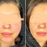 ژل،بوتاکس،مزو،چال لپ،فیلر|خدمات آرایشگری و زیبایی|قم, عمار یاسر|دیوار
