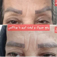 لیزر بوتاکس ژل خالبرداری|خدمات آرایشگری و زیبایی|سیرجان, |دیوار