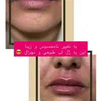 مطب زیبایی در کرمان با ضمانت صد در صد بوتاکس|خدمات آرایشگری و زیبایی|کرمان, |دیوار