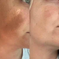 روشن شدن نواحی تیره بدن|خدمات آرایشگری و زیبایی|مشهد, الهیه|دیوار