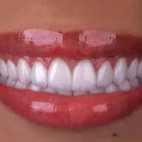 دندانپزشکی ، کامپوزیت ، عصب کشی ، روکش