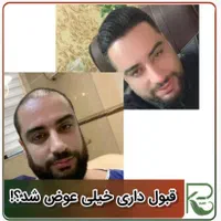 کاشت مو و ابرو و ریش تارکوب