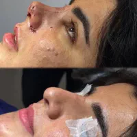 آف عمل  زیبایی دماغ ۲۵ت دراهوازتااخرهفته