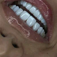 آف ویژه خدمات تخصصی کامپوزیت دندان