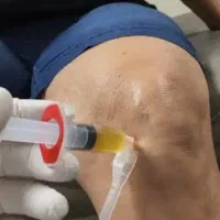 درمان آرتروز زانو/به روش پلاسما|خدمات آرایشگری و زیبایی|خرم‌آباد, |دیوار