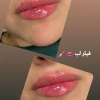 فیلر وبوتاکس|خدمات آرایشگری و زیبایی|گرگان, |دیوار