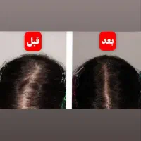 درمان ریزش مو با بیش از 3922 درمان موفق