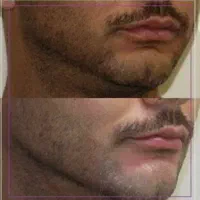 بوتاکس،فیلر،مادلینگ صورت،انواع جوانساز|خدمات آرایشگری و زیبایی|کرمانشاه, |دیوار
