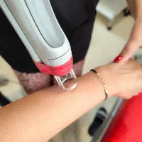 لیزر موهای زائد با دستگاه کندلاباکولینگ2025