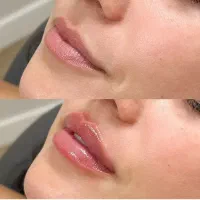 فیلر نخ مزوآنزیم چالگونه ساپسیژن
