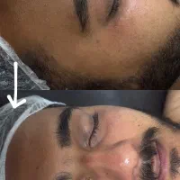 فشیال صورت(تخفیف ویژه)
