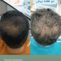 درمان ریزش مو