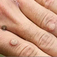 رفع کامل زگیل و تبخال تناسلی