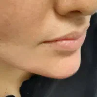 فیلر و بوتاکس تخفیف شب یلدا|خدمات آرایشگری و زیبایی|قم, باسکول|دیوار