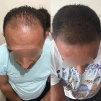 قطع ریزش مو و پرپشتی مو فقط با تکنیک اکسونیک