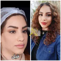 جراحی بینی در شیراز/نوبتگیری +وام+مشاوره|خدمات آرایشگری و زیبایی|لار, |دیوار