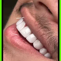 کامپوزیت دندان/لمینیت/دندانپزشکی/ترمیم/عصبکشی|خدمات آرایشگری و زیبایی|تهران, جردن|دیوار