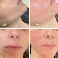 معجزه جوانسازی(پی آر پی)|خدمات آرایشگری و زیبایی|اردبیل, |دیوار