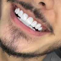 کامپوزیت دندان و روکش سرامیک دندان ایمپلنت|خدمات آرایشگری و زیبایی|تهران, صادقیه|دیوار
