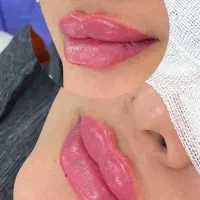 جشنواره تزریق فیلر،بوتاکس ،نخ،لاغری و هایفو