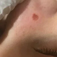 پاکسازی پوست دائمی|خدمات آرایشگری و زیبایی|قرچک, میرزائی جنوبی|دیوار