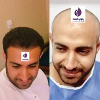 تخفیف پاییز تا یلدا کاشت مو و ابرو و مژه|خدمات آرایشگری و زیبایی|زاهدان, |دیوار