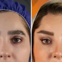 آف۲۰روز/۴۰٪لیفت شقیقه وجراح پلاستیک بدن/دستگاه پال|خدمات آرایشگری و زیبایی|مشهد, کوه سنگی|دیوار