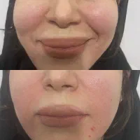 زیبایی فیلر بوتاکس