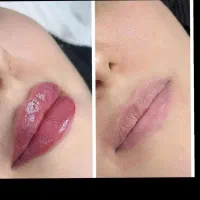 جشنواره تخفیف ویژه تزریق ژل و بوتاکس|خدمات آرایشگری و زیبایی|اصفهان, بوستان آینه خانه|دیوار