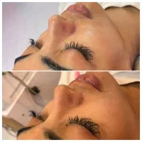 آموزش فیشال و پاکسازی صورت