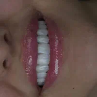 خدمات فوق تخصصی کامپوزیت بدون پیش پرداخت