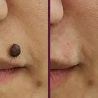 برداشت انواع خال،جوش،لک،کک و‌مک وضایعات پوستی|خدمات آرایشگری و زیبایی|تهران, سنائی|دیوار