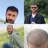 کاشت موی نقدی ، اقساطی و تضمینی
