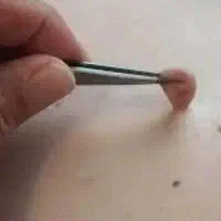 برداشتن خال ومنگوله های گوشتی بدون درد و خونریزی