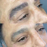 رفع نواقص ابرو و رفع کبودی و تیرگی لب