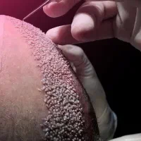 کاشت مو و ابرو