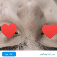 فیشال تخصصی پاکسازی۲۰۰تومان مزو کربوکسی اسیدتراپی|خدمات آرایشگری و زیبایی|مشهد, هدایت|دیوار
