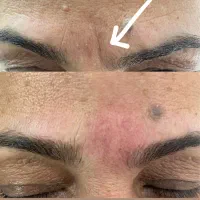 ژل. مزو ژل. جوانساز. بوتاکس|خدمات آرایشگری و زیبایی|کرج, حصارک پایین|دیوار