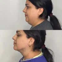 تخلیه غب غب