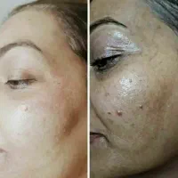 زیبایی لیفت بلفارو فرم بینی بوتاکس نخ ابروزاویه ژل|خدمات آرایشگری و زیبایی|اصفهان, خانه اصفهان|دیوار