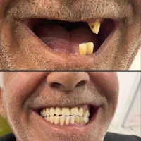 دندان سازی مروارید۳۰٪ اف|خدمات آرایشگری و زیبایی|بهبهان, |دیوار