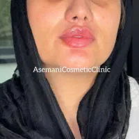 مدل برای تزریق فیلر،بوتاکس،مزو،آنزیم تحت نظر پزشک|خدمات آرایشگری و زیبایی|مشهد, آزادشهر|دیوار