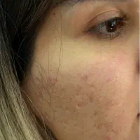 لیزر co2 تخفیف ویژه حذف اسکار،منافذوتیرگی ها مزو|خدمات آرایشگری و زیبایی|تهران, زعفرانیه|دیوار