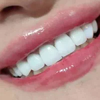 لمینت مترحک دندان اصل|آرایشی، بهداشتی، درمانی|ایلام, |دیوار