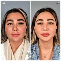 ۵۰ درصد تخفیف تزریق صورت سبک عربی هالیوودی لب روسی|خدمات آرایشگری و زیبایی|ری, دیلمان|دیوار