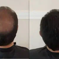 باما دیگه قراره نیست کچل باشی